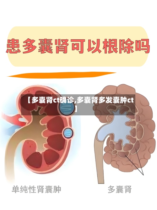 【多囊肾ct确诊,多囊肾多发囊肿ct】-第2张图片
