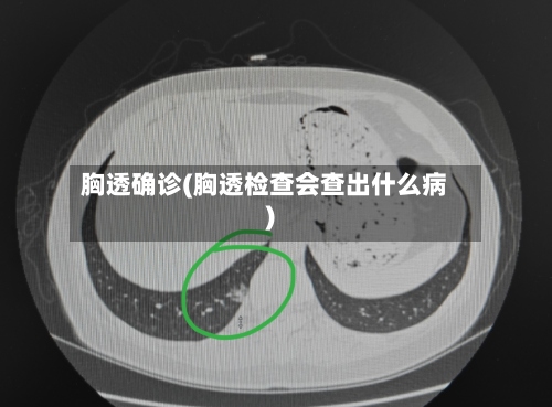 胸透确诊(胸透检查会查出什么病)