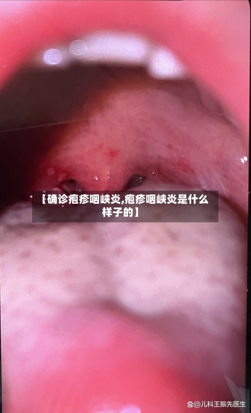 【确诊疱疹咽峡炎,疱疹咽峡炎是什么样子的】-第3张图片