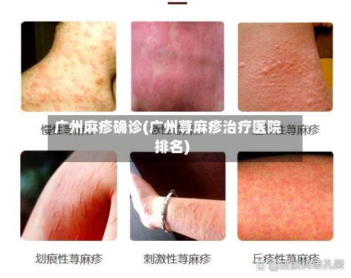 广州麻疹确诊(广州荨麻疹治疗医院排名)