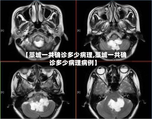 【藁城一共确诊多少病理,藁城一共确诊多少病理病例】