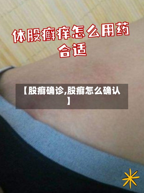 【股癣确诊,股癣怎么确认】