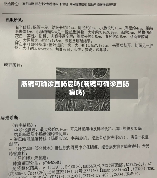 肠镜可确诊直肠癌吗(肠镜可确诊直肠癌吗)