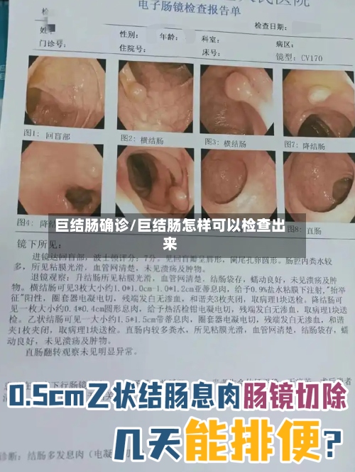 巨结肠确诊/巨结肠怎样可以检查出来