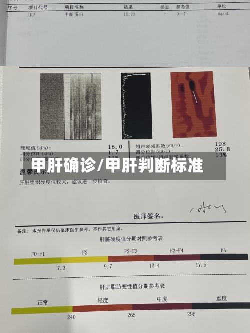 甲肝确诊/甲肝判断标准-第2张图片