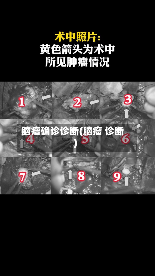 脑瘤确诊诊断(脑瘤 诊断)