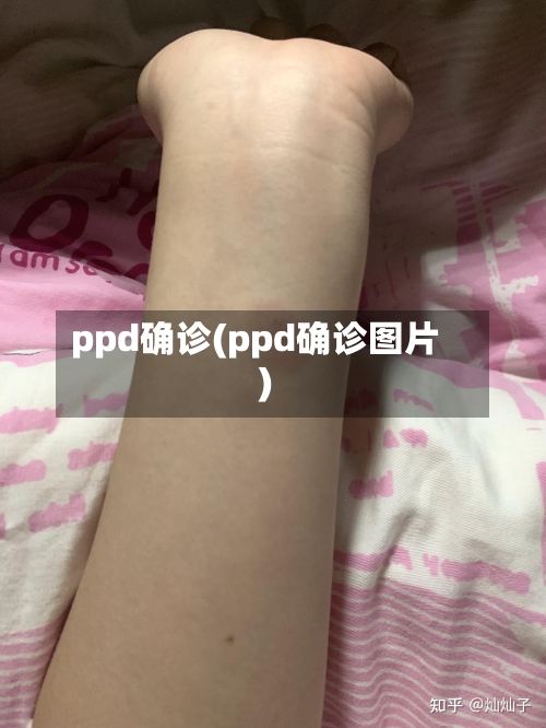 ppd确诊(ppd确诊图片)-第2张图片
