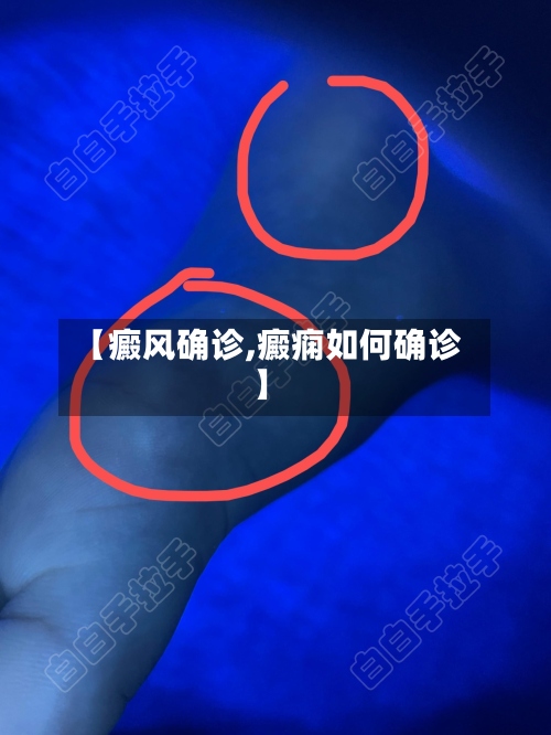【癜风确诊,癜痫如何确诊】-第2张图片