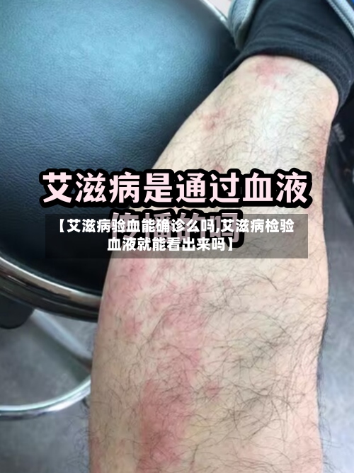 【艾滋病验血能确诊么吗,艾滋病检验血液就能看出来吗】-第2张图片