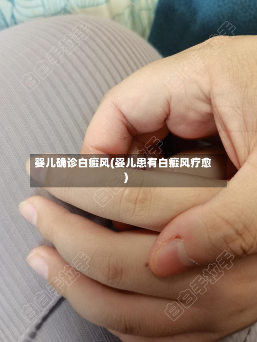 婴儿确诊白癜风(婴儿患有白癜风疗愈)
