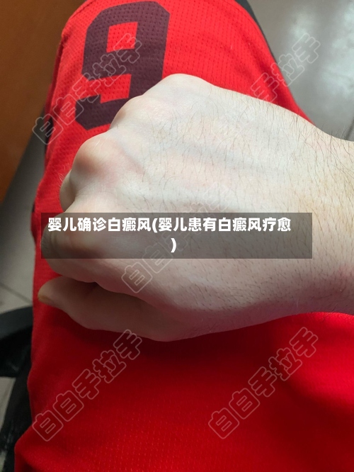 婴儿确诊白癜风(婴儿患有白癜风疗愈)-第3张图片