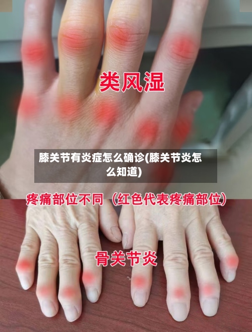 膝关节有炎症怎么确诊(膝关节炎怎么知道)