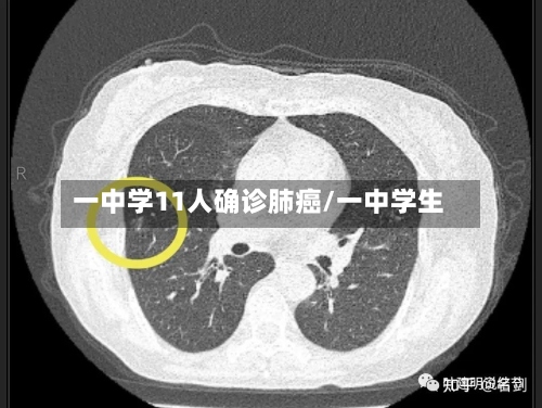 一中学11人确诊肺癌/一中学生-第3张图片