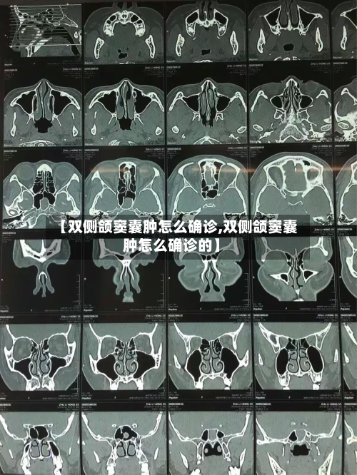 【双侧颌窦囊肿怎么确诊,双侧颌窦囊肿怎么确诊的】-第3张图片
