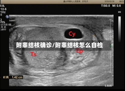 附睾结核确诊/附睾结核怎么自检-第3张图片