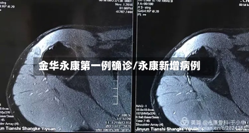 金华永康第一例确诊/永康新增病例-第3张图片