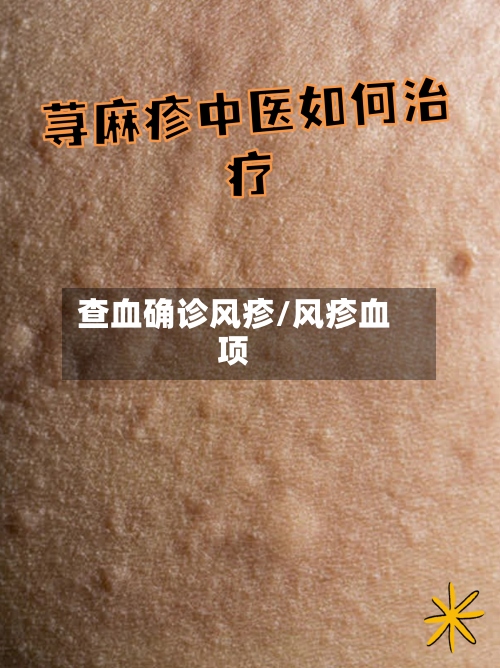 查血确诊风疹/风疹血项