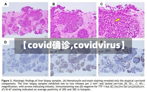 【covid确诊,covidvirus】