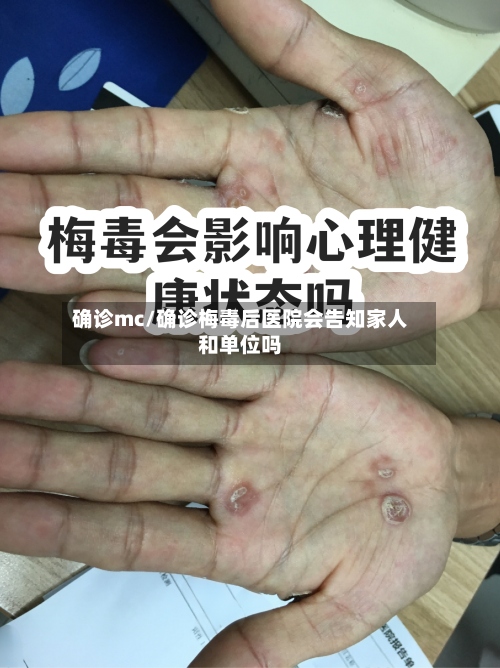 确诊mc/确诊梅毒后医院会告知家人和单位吗