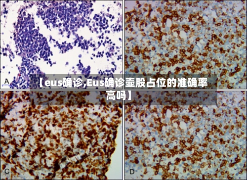 【eus确诊,Eus确诊壶股占位的准确率高吗】-第2张图片