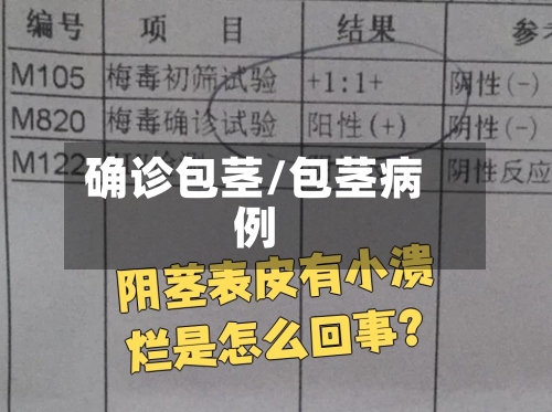 确诊包茎/包茎病例-第2张图片