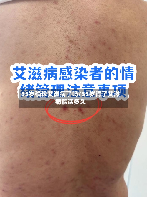 55岁确诊艾滋病了吗/55岁得了艾滋病能活多久