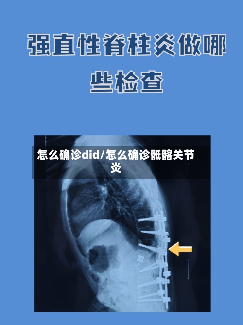 怎么确诊did/怎么确诊骶髂关节炎