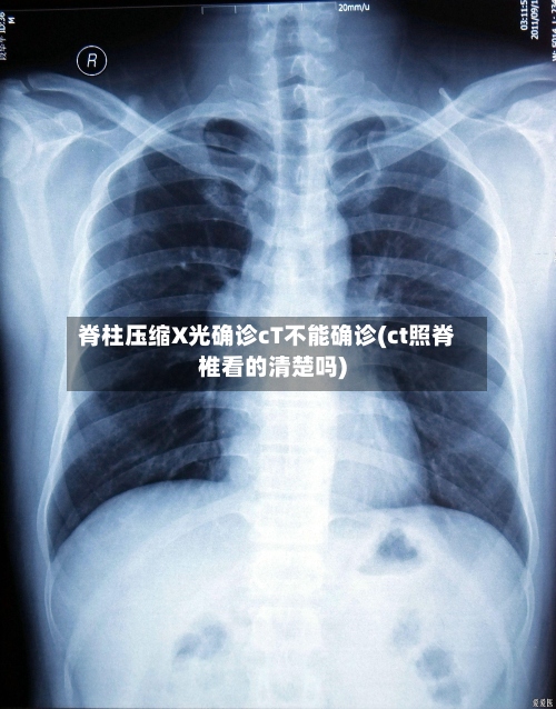 脊柱压缩X光确诊cT不能确诊(ct照脊椎看的清楚吗)-第2张图片